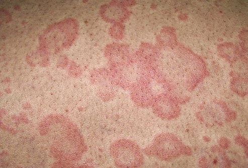 Topical steroids for urticaria