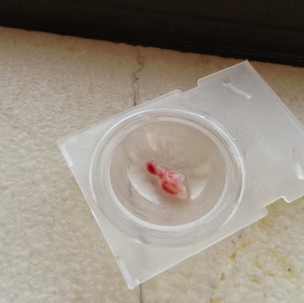 Misoprostol Abortion Experience