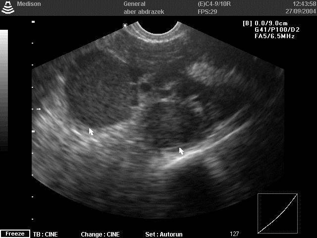 Bilateral ovarian endometrioma (kissing ovaries)- diagnosed by TVS -done by Dr. Alaa Mosbah