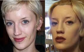 non surgical nose job nose surgery