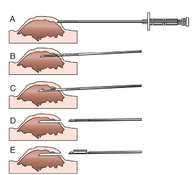 Servicio de Anatomía Patológica Veterinaria Biopsia con TruCut