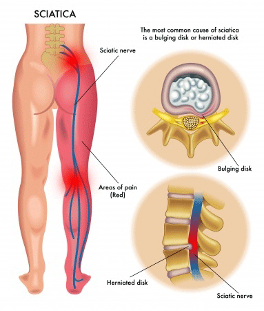 sciatica-symptoms-treatment