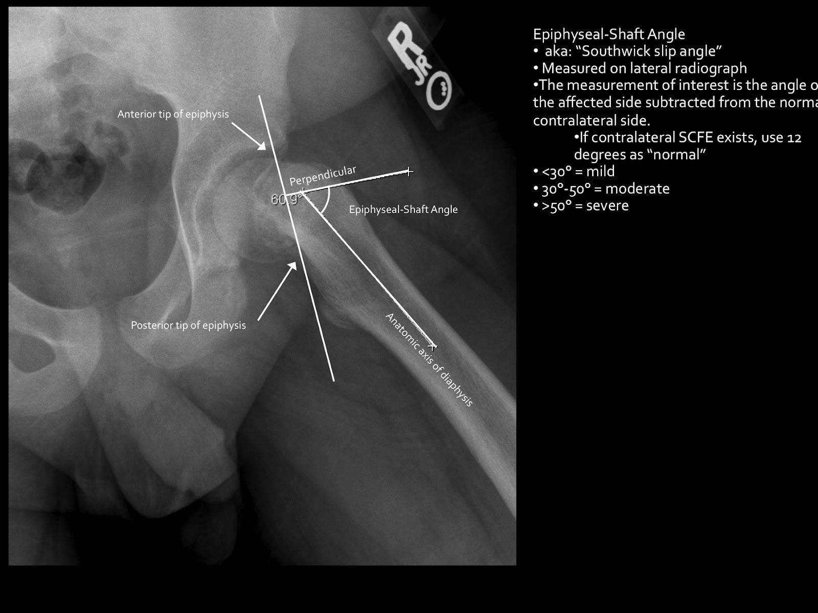 MRI Musculo-Skeletal Section: Slipped capital femoral epiphysis