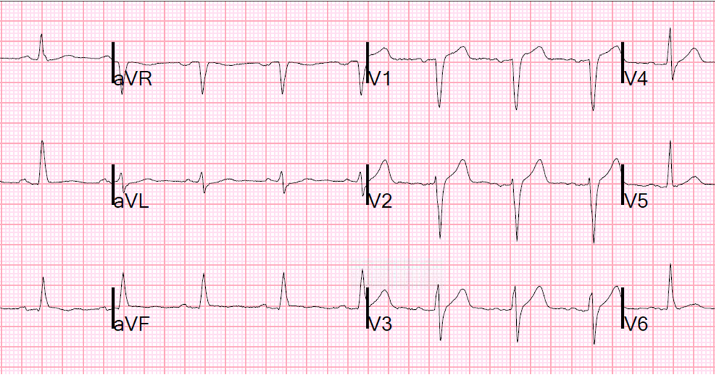 Dr. Smith's ECG Blog Chest pain in a patient with previous inferior