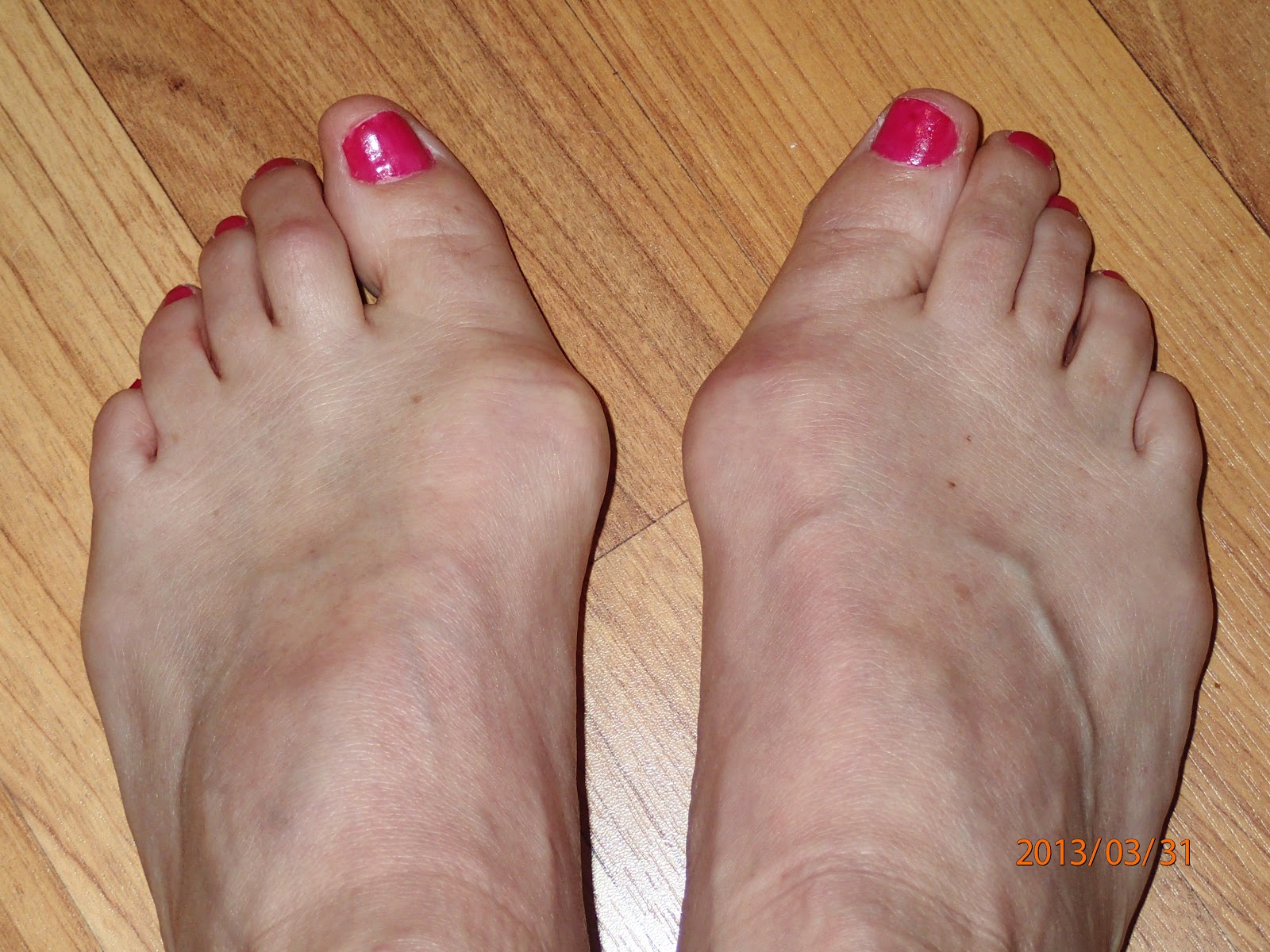Treatment For Hammer Toe Pain