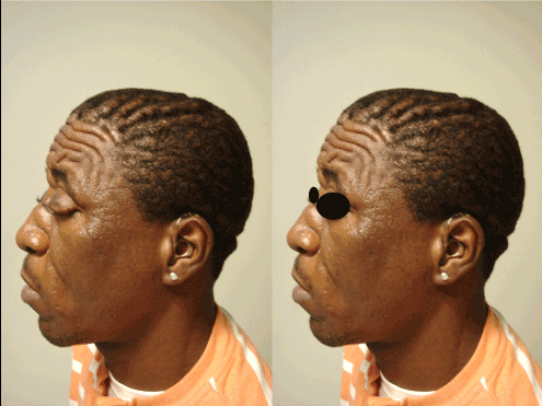 cutis gyrata scalp disease condition ridges cvg bar hypertrophy folds skin medical conditions cure