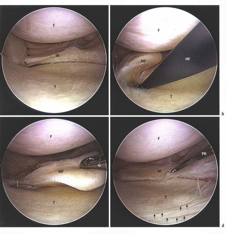 LES LESION MENISCAL