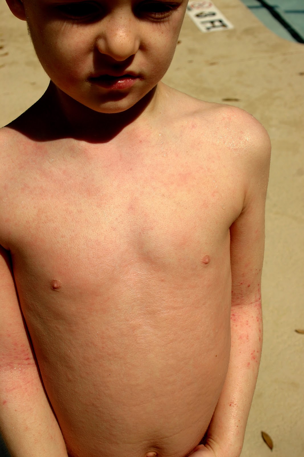 Meth Rash