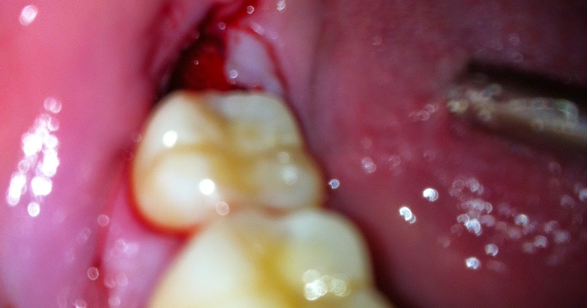 wisdom teeth removal tooth socket complications dental