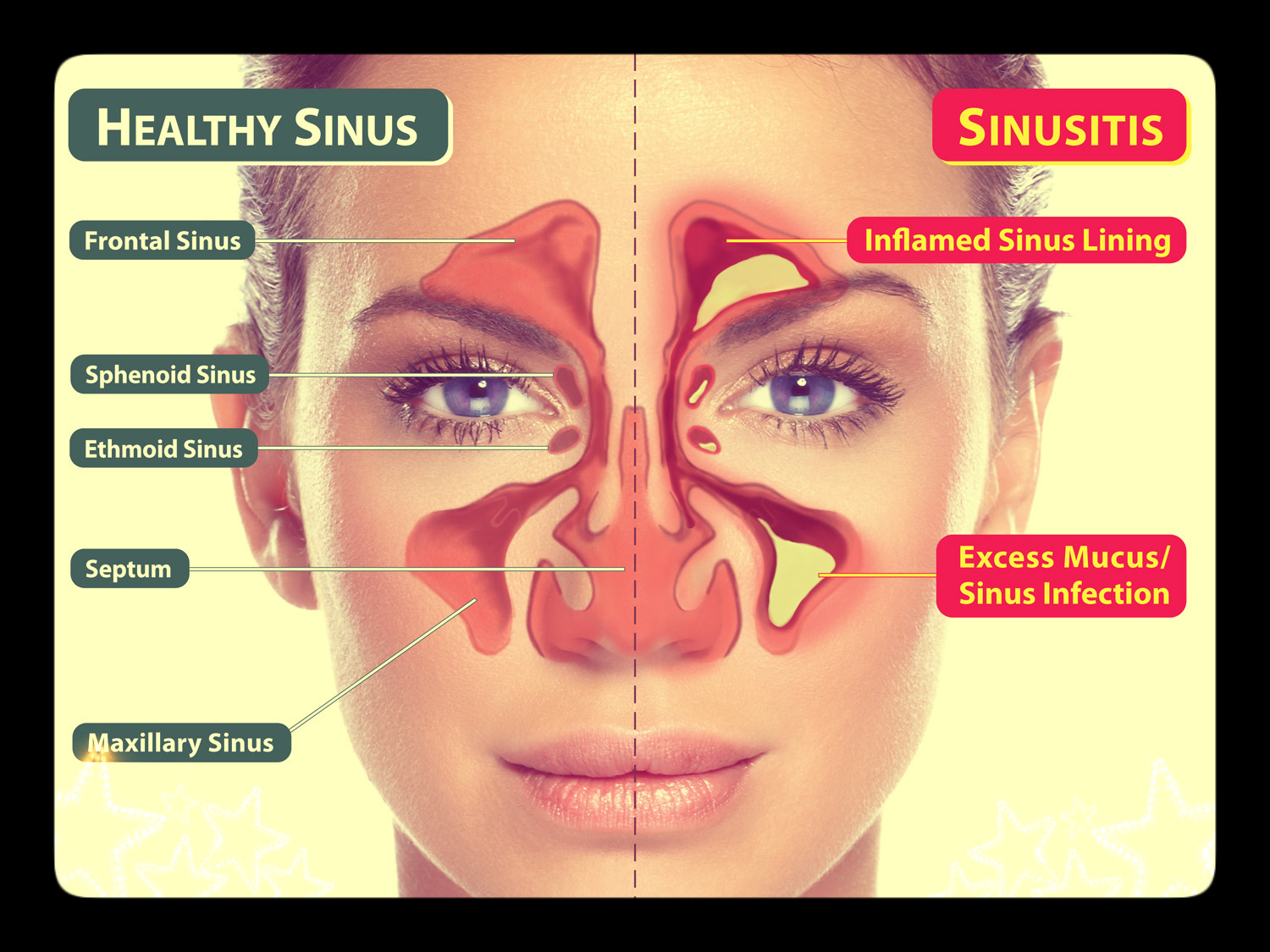 Mata Dan Penglihatan Petua Rawat Sinusitis Atau Resdung Dengan 3 Langkah