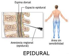 Inyeccion epidural esteroides cervical