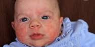 Baby acne how to treat