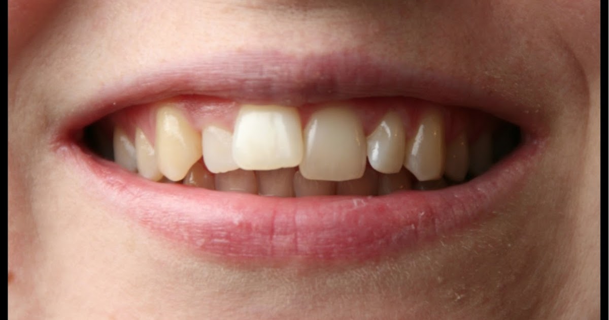 invisalign week three journey