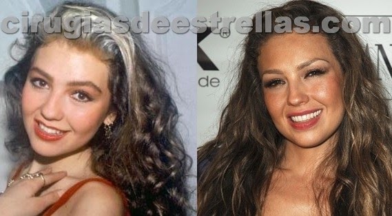 Rinoplastia De Thalia Cirugias De Estrellas | rinoplastia de thalia cirug 237 as de estrellas Rinoplastia De Thalia Cirugias De Estrellas | rinoplastia de thalia cirug 237 as de estrellas