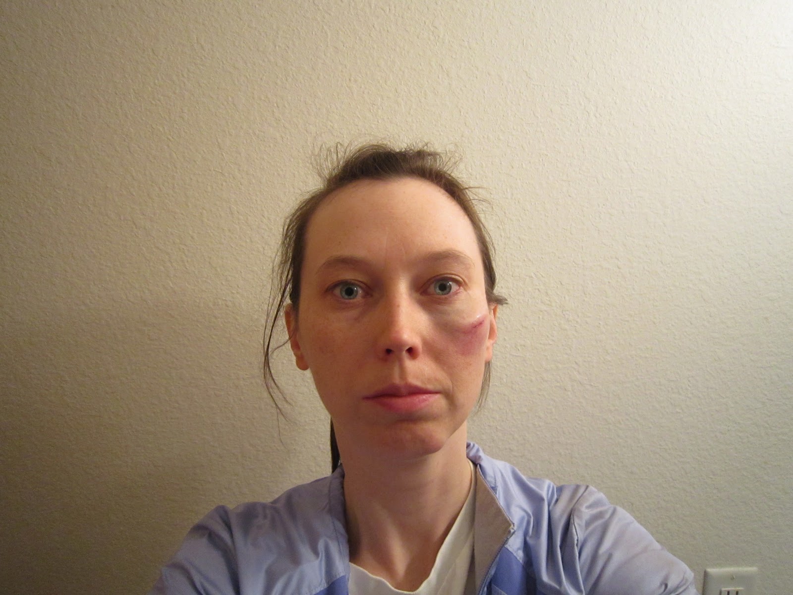 befuddled bug's blog of bewilderment My First Black Eye!!!