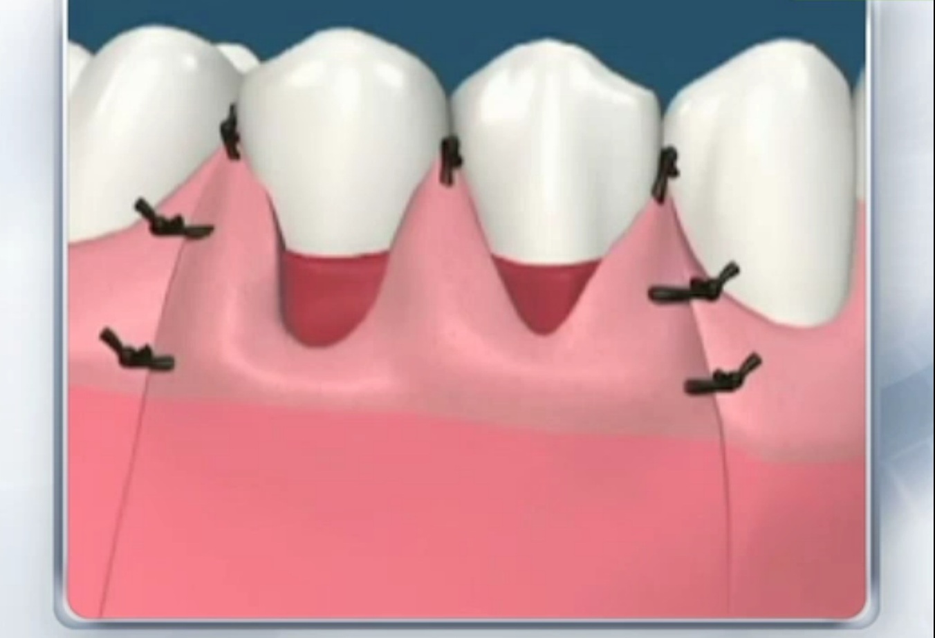 Sağlık Diş Eti Sorunları