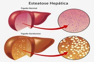 Exame gordura no figado