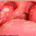How To Get Rid of Strep Throat Faster And Better Without Antibiotics