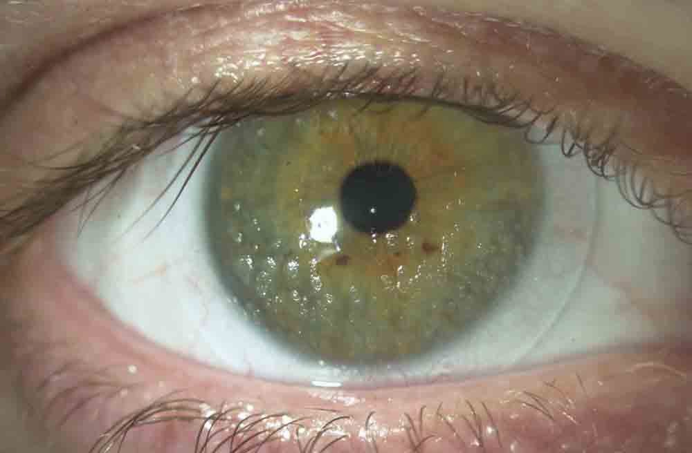 Makeup Debris On Your Contact Lenses Air Optix Aqua May Be The Lens This Soft Contact Lens Shows Multiple Areas Of Debris On The Surface That Create Comfort And Significant Vision Issues Not To Mention Vastly Increase
