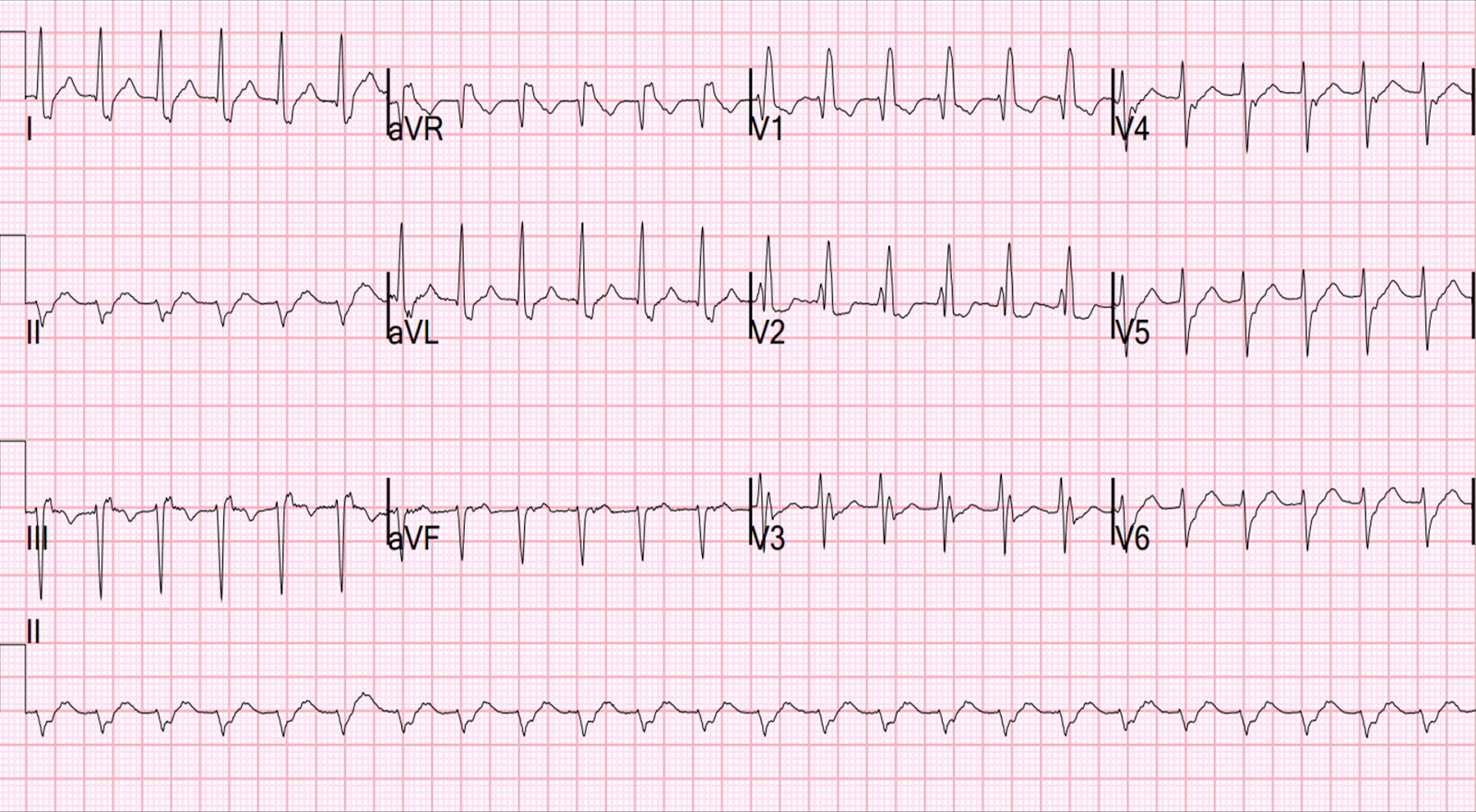 Dr. Smith's ECG Blog: Paroxysmal SVT (PSVT) that repeatedly recurs in