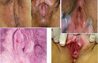 Obat Luka Lecet Pada Bagian Dalam Vagina
