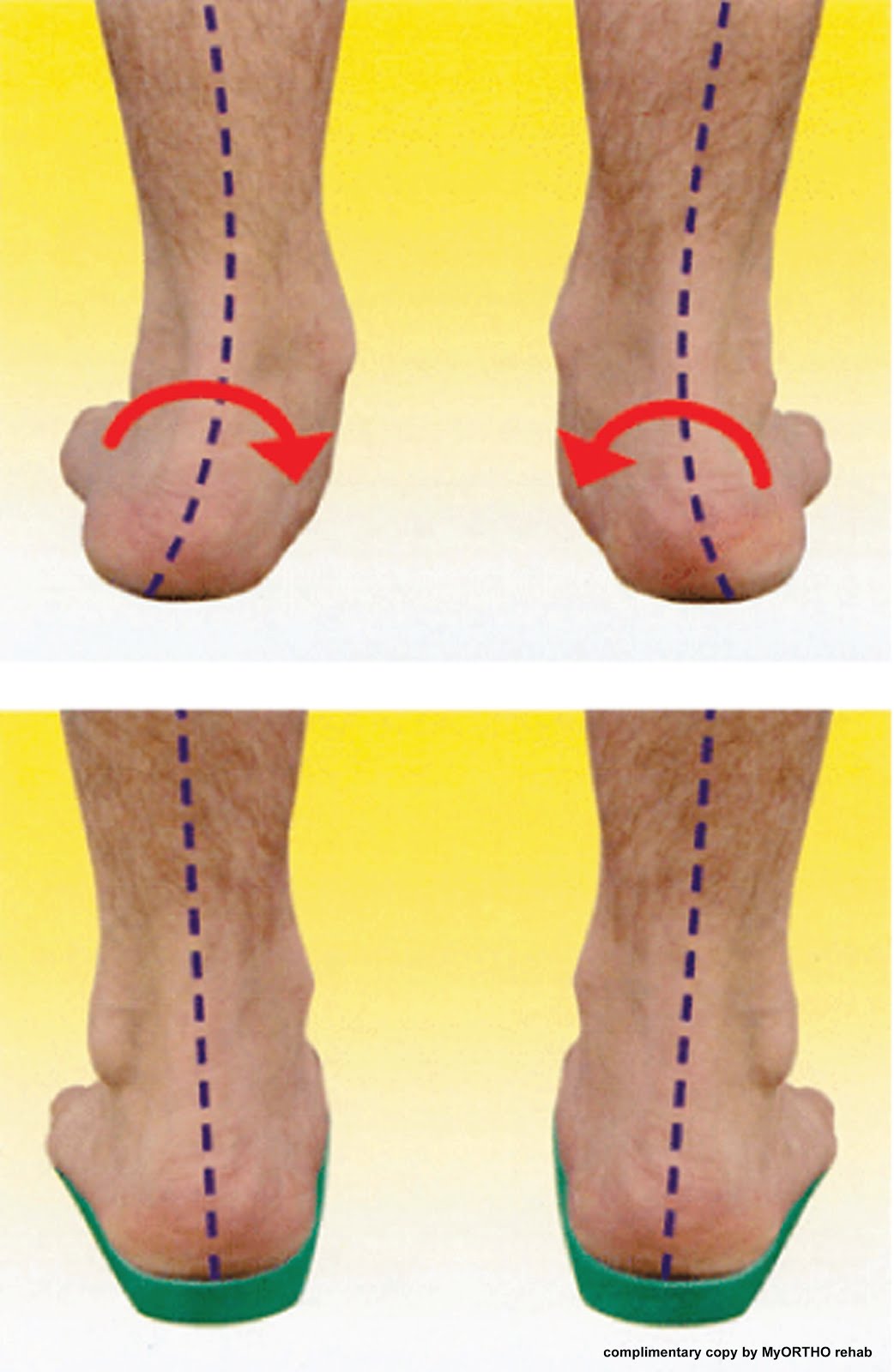 Common Foot Problems In Children Parenting Times