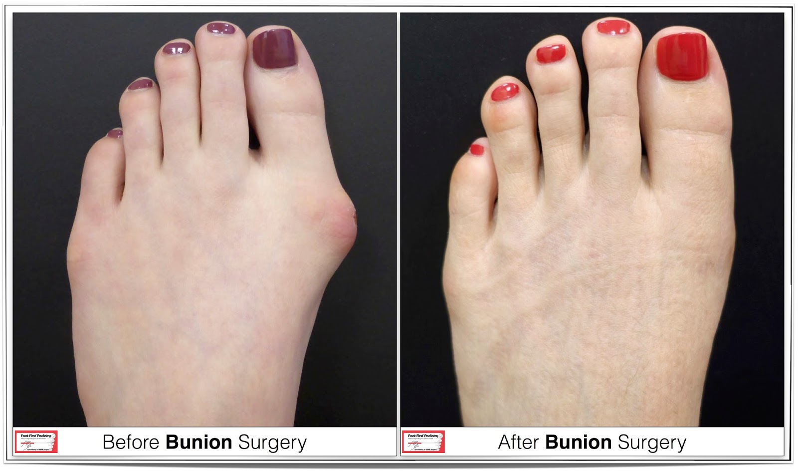 Swiss Compression Technique for Correcting Bunions