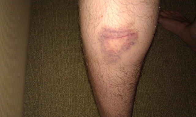 weird bruise