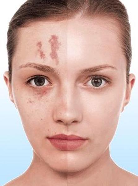 Best Makeup Concealing Scars Best Makeup Concealing Scars