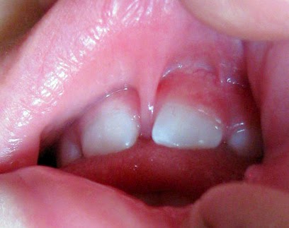 What medications could cause a swollen upper lip?