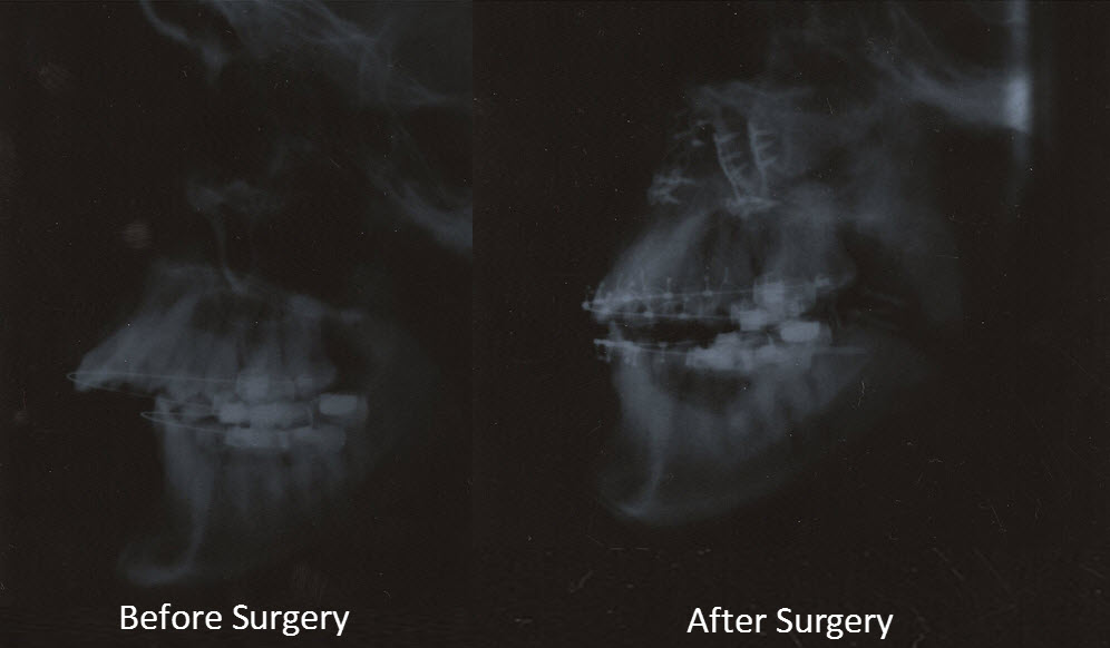 Double Jaw Operation The Road to Recovery