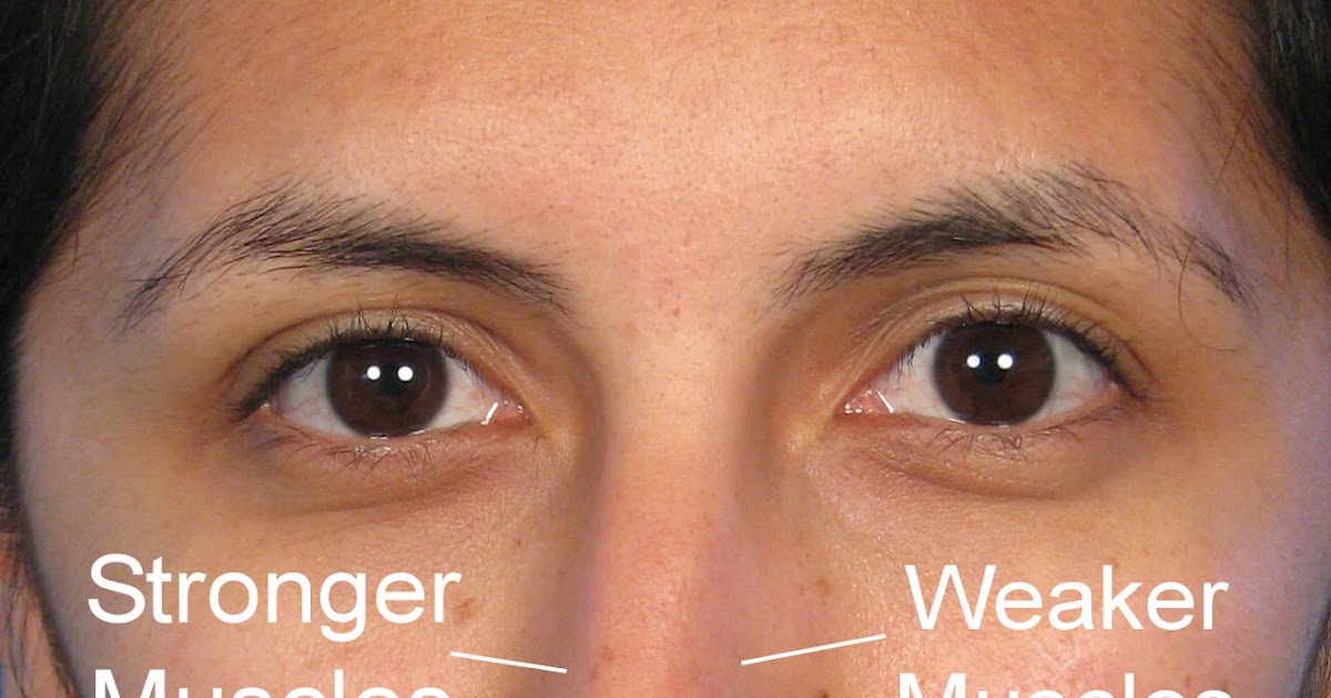 Cardio Trek Toronto Personal Trainer Fixing a Crooked Nose using