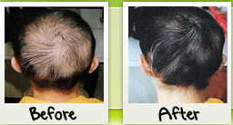 miracle-hair-regrowth