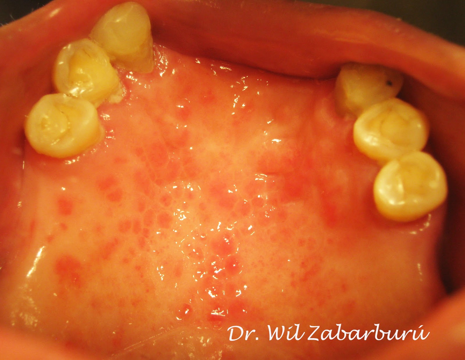 CLINICA DENTAL ASISTENCIAL CANDIDIASIS ERITEMATOSA CRÓNICA