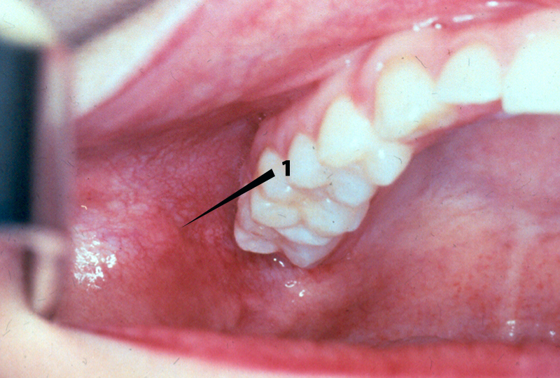 Diseases of the Oral Cavity and Oropharynx November 2015