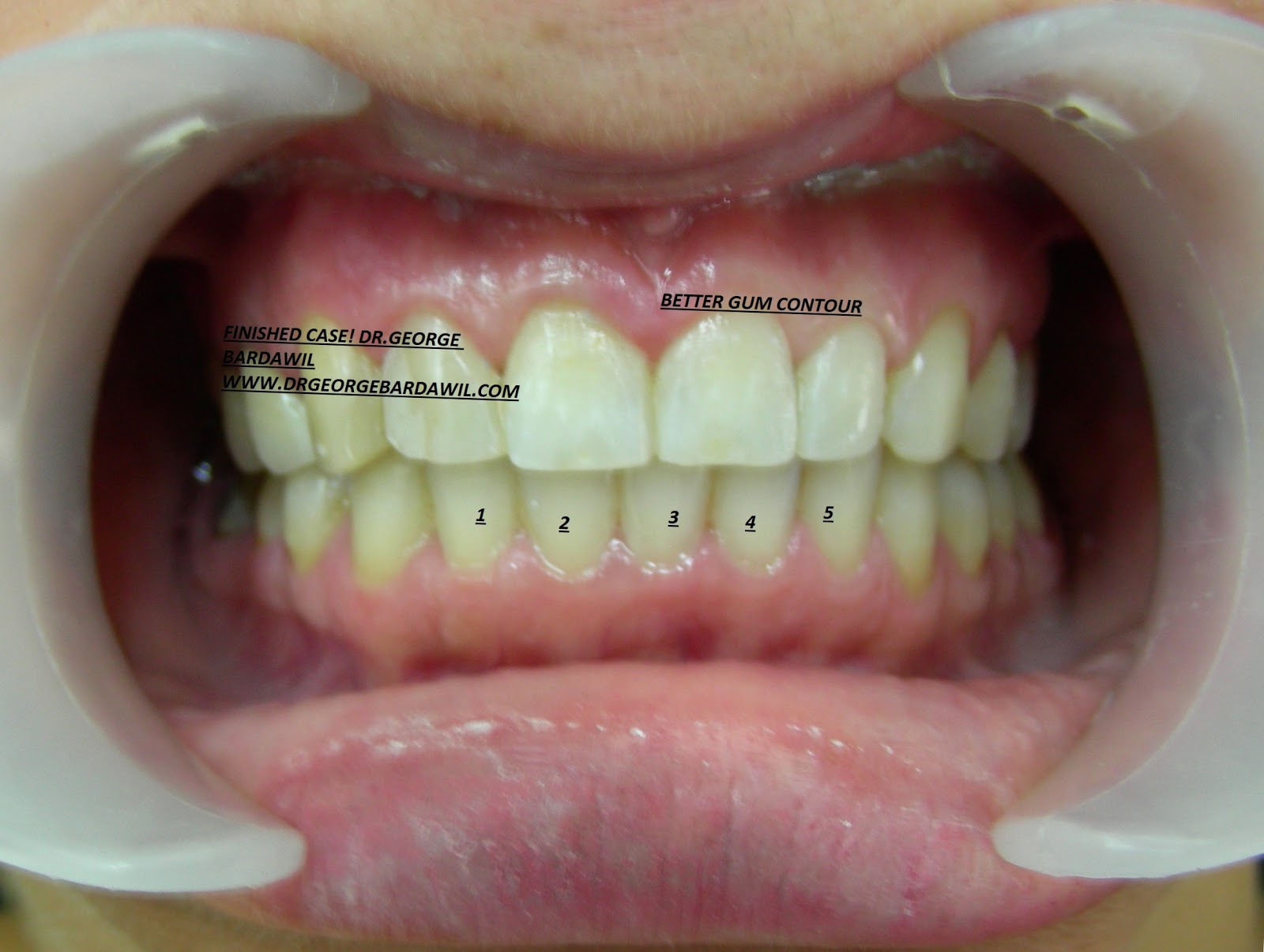 E. BardawilOrthodontistInvisalign Diamond level Gaps
