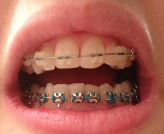 teeth filed down for veneers