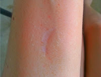 Scar on Arm