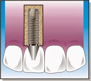 www.dentistinchennai.com/implant-procedures.php