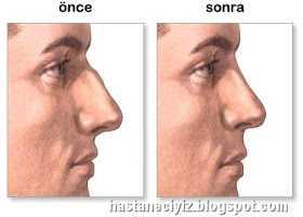 burun estetiği burun estetiği, estetik burun ameliyatı