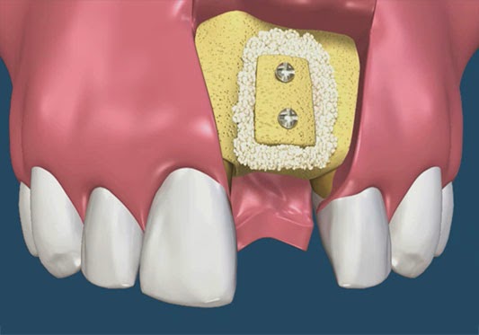 greffe osseuse parodontale