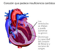 ¿Cómo es un corazón con insuficiencia?