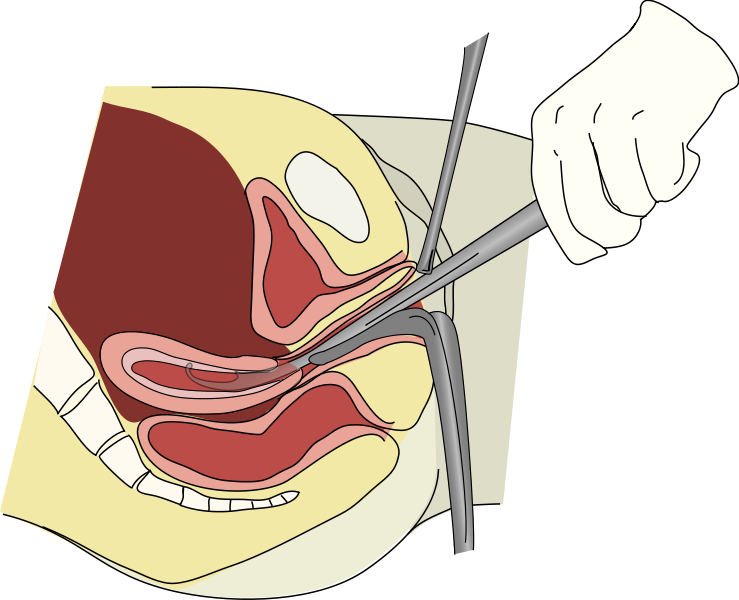Dilatation and curettage