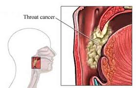 Causes Symptoms of Throat Cancer and Healing
