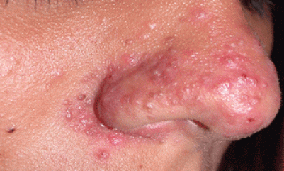 Side effects of steroid injections for psoriasis