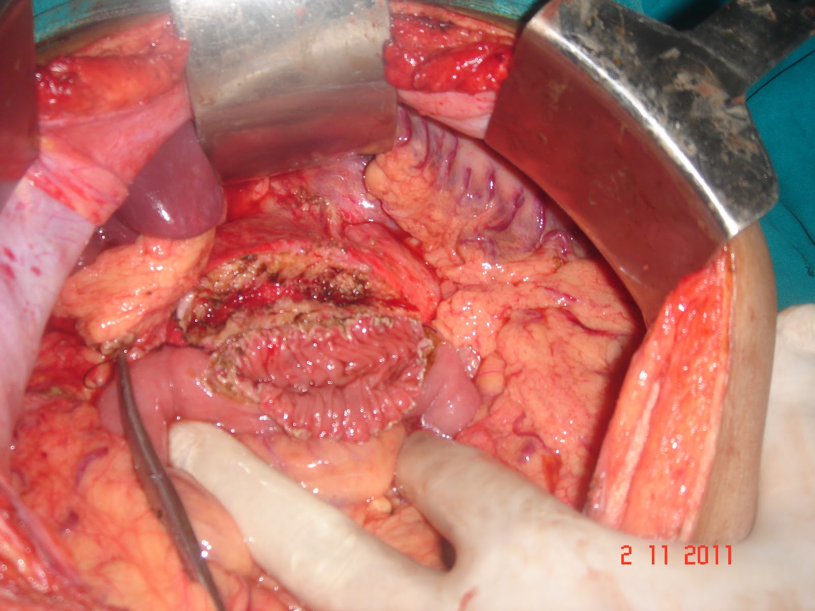 Dr Rahul Naik's Blog on Gastroenterology, GI, Laparoscopic and