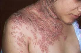Herpes Tubuh Herpes Tubuh