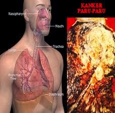 Cara Alami Menyembuhkan Kanker Paru-Paru Cara Alami Menyembuhkan Kanker Paru-Paru
