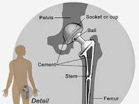 Hip Diagram Hip Diagram