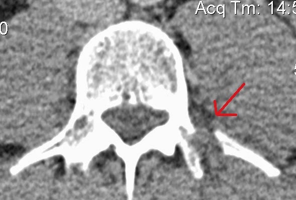 collapsed disk xray collapsed disk xray
